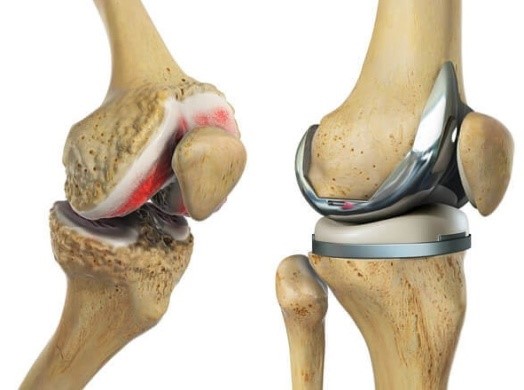 Tidak Pakai BPJS! Sediakan Biaya Khusus Untuk TKR Lutut